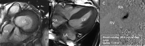 Multimodality Imaging of a Gerbode Defect 